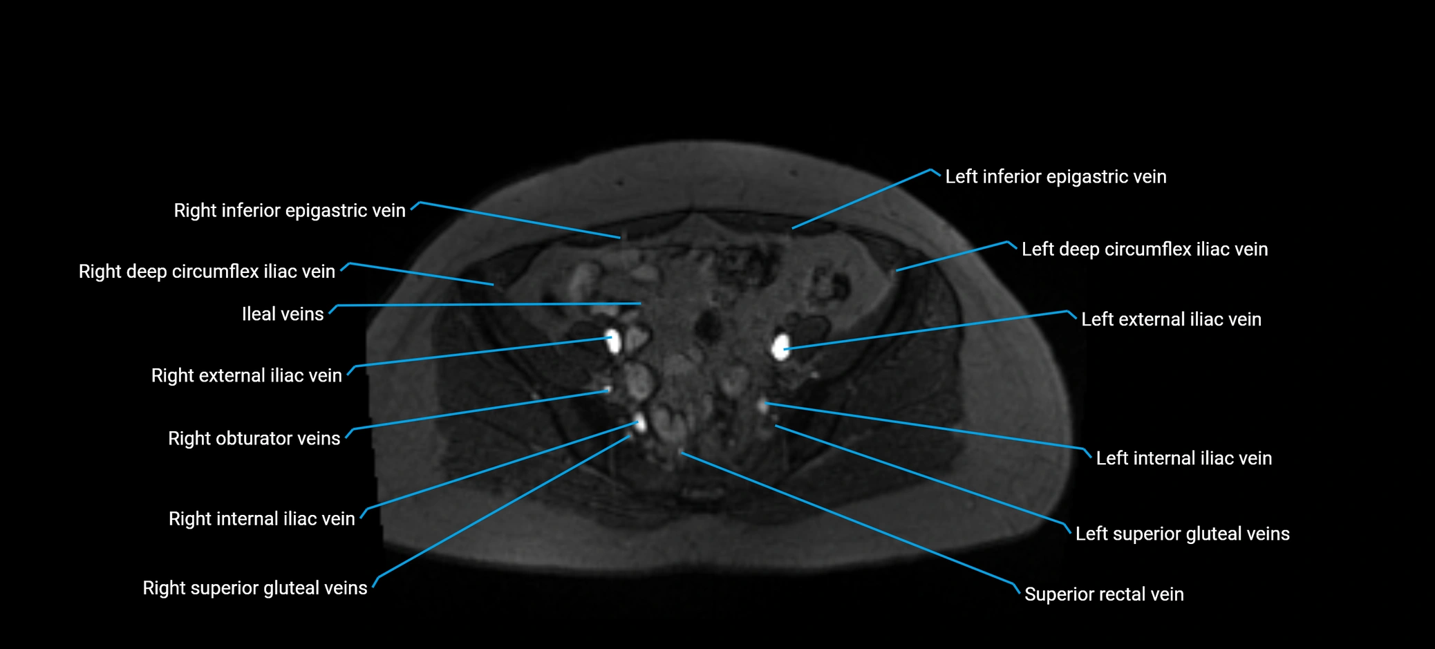 MRV abdomen pelvis & lower limb axial cross sectional anatomy labelled MRI image 145 (1).webp